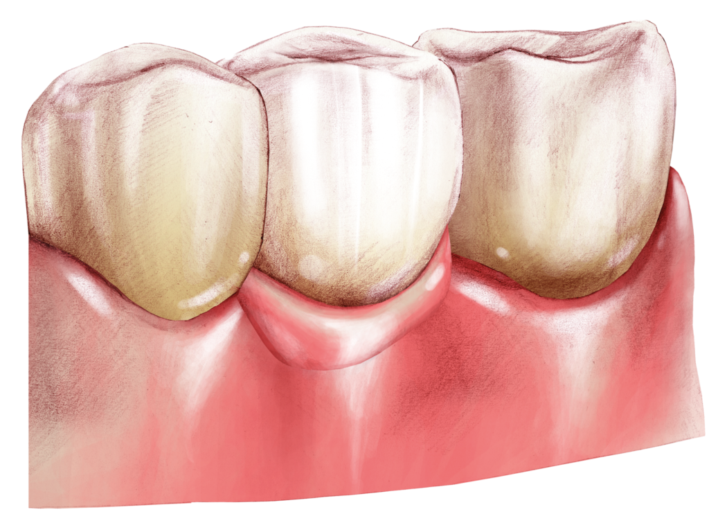 Ricostruzione del dente con COLOURANT