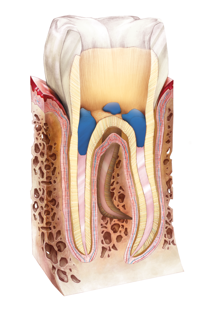Marcatura e protezione degli orifizi canalari dopo il trattamento endodontico