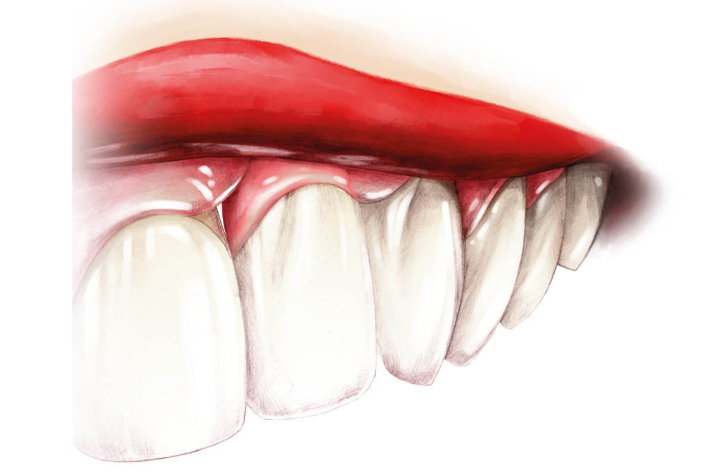 Miglioramento dell’estetica nelle aree che richiedono l’uso di compositi in colori non dentali