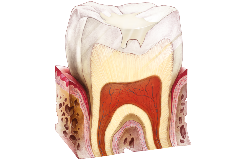 Sigillatura dei denti con carie superficiale
