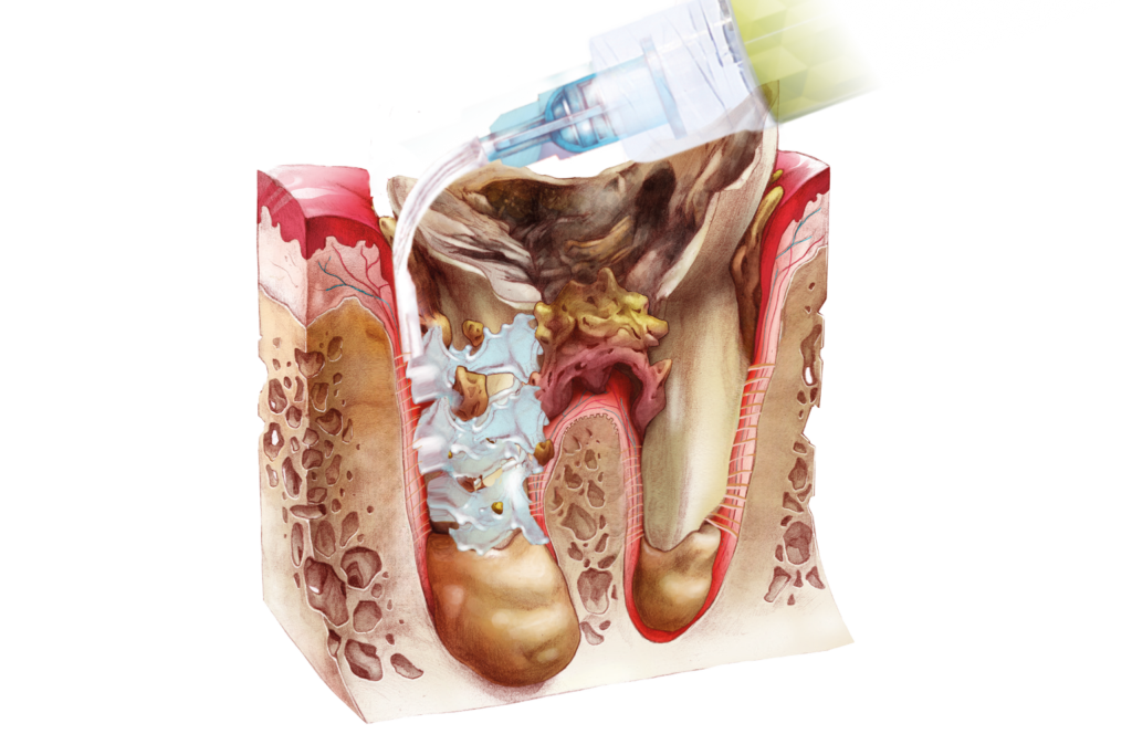 Tasche gengivali adiacenti al dente da estrarre