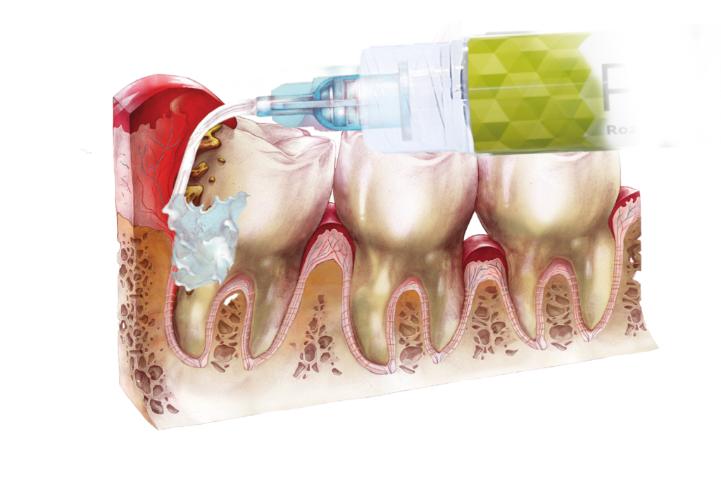 Aree intorno ai denti con eruzione difficoltosa, in particolare i denti del giudizio